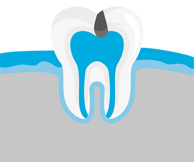 Karies im Zahn